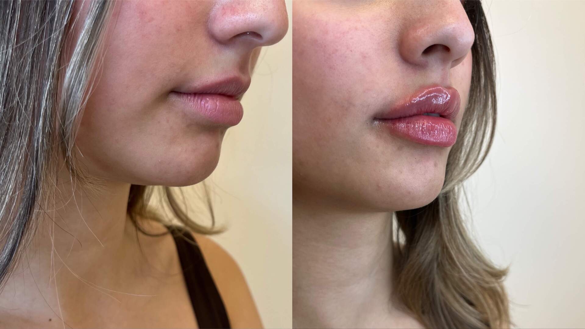 dermal-filler-before-after-1