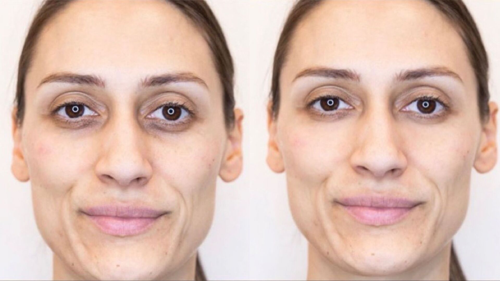 dermal-filler-before-after-2