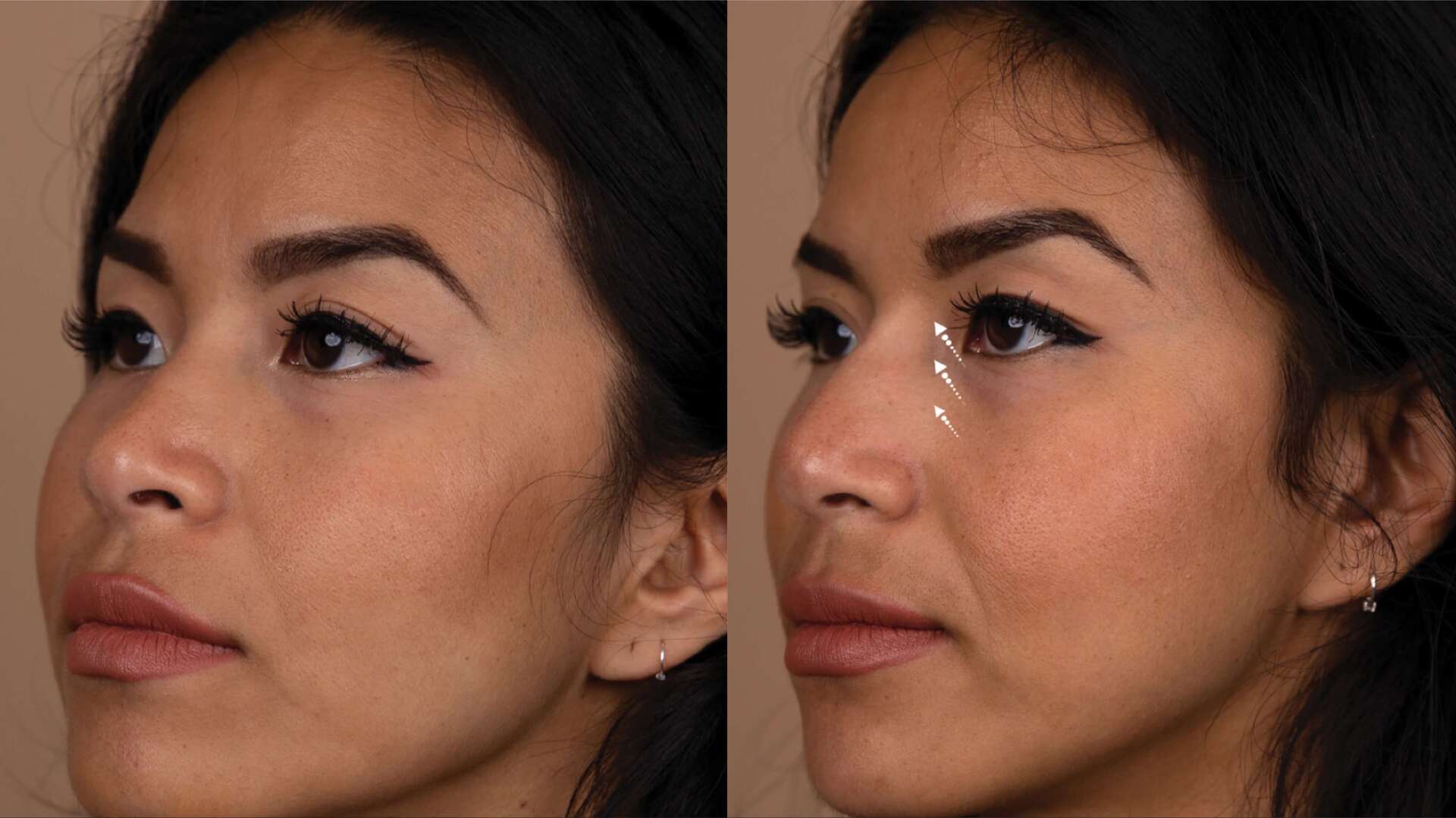 dermal-filler-before-after-4