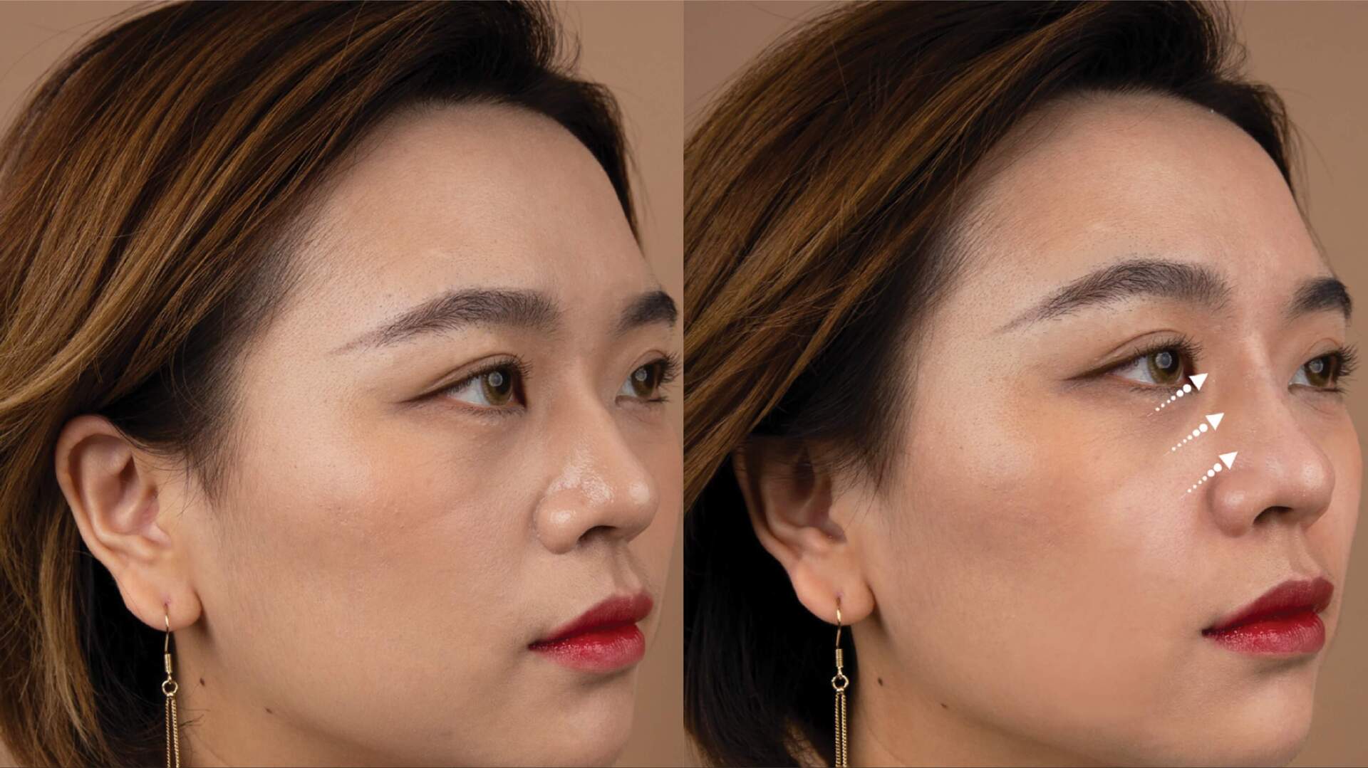 dermal-filler-before-after-5